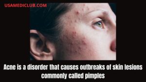 Read more about the article Acne is a disorder that causes outbreaks of skin lesions commonly called pimples