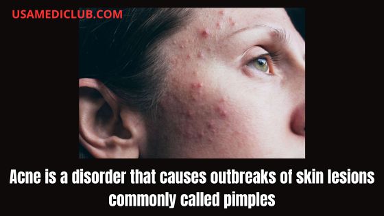 Acne is a disorder that causes outbreaks of skin lesions commonly called pimples